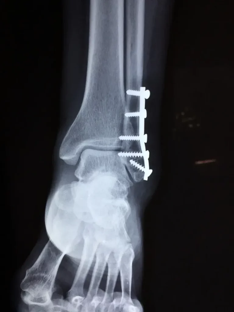 x-ray of a person's ankle with screws to repair a fracture