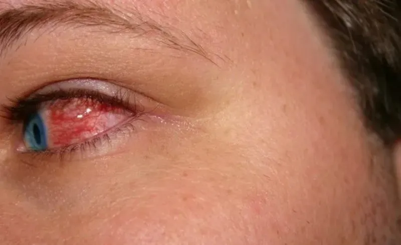 person with pink eye