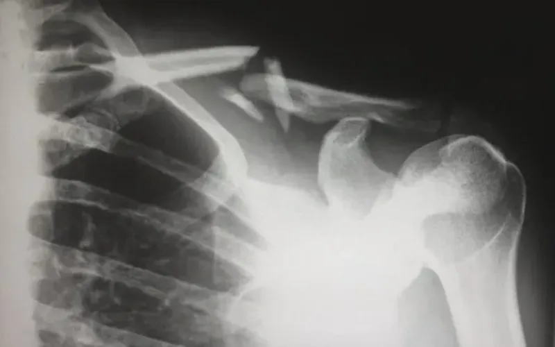 x-ray of a human's broken shoulder